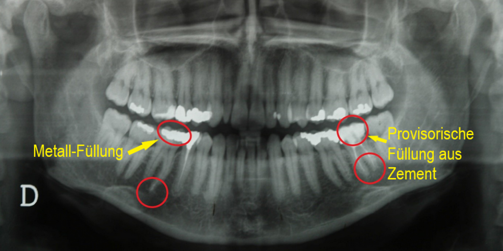 Schwermetalle/Ablagerungen an Zahnwurzeln